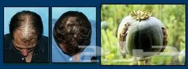 0 لحل مشاكل التساقط وإنبات فراغات الذقن . (image 35)