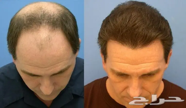 زراعة الشعر بالسعودية