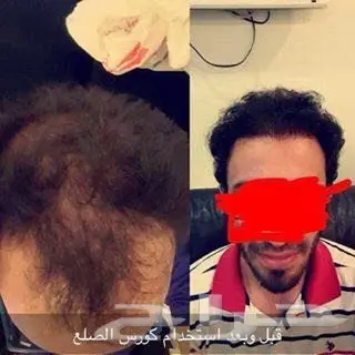 منبت الشعر والصلع الوراثي والفراغات  (image 9)