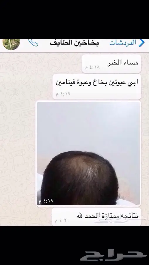 منبت الشعر والصلع الىوراثي والفرغات  (image 19)