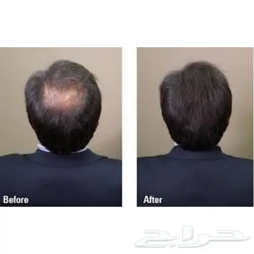 إذا تعاني من الصلع لايفوتك عرض نهاية العام