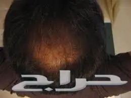 ألياف للصلع(تصفية أشتري 2 والثالث مجانا)  (image 18)