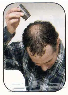 ألياف للصلع(تصفية أشتري 2 والثالث مجانا)  (image 1)