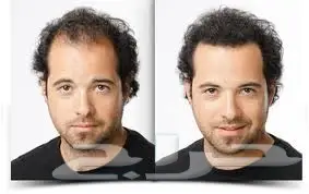 ألياف للصلع(تصفية أشتري 2 والثالث مجانا)  (image 8)