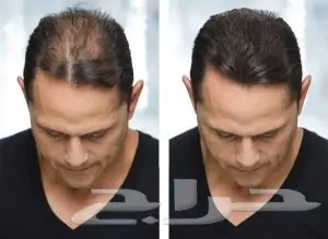 ألياف للصلع(تصفية أشتري 2 والثالث مجانا)  (image 28)