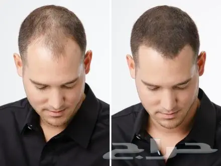 ألياف للصلع(تصفية أشتري 2 والثالث مجانا)  (image 27)