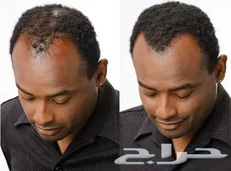 ألياف للصلع(تصفية أشتري 2 والثالث مجانا)  (image 21)