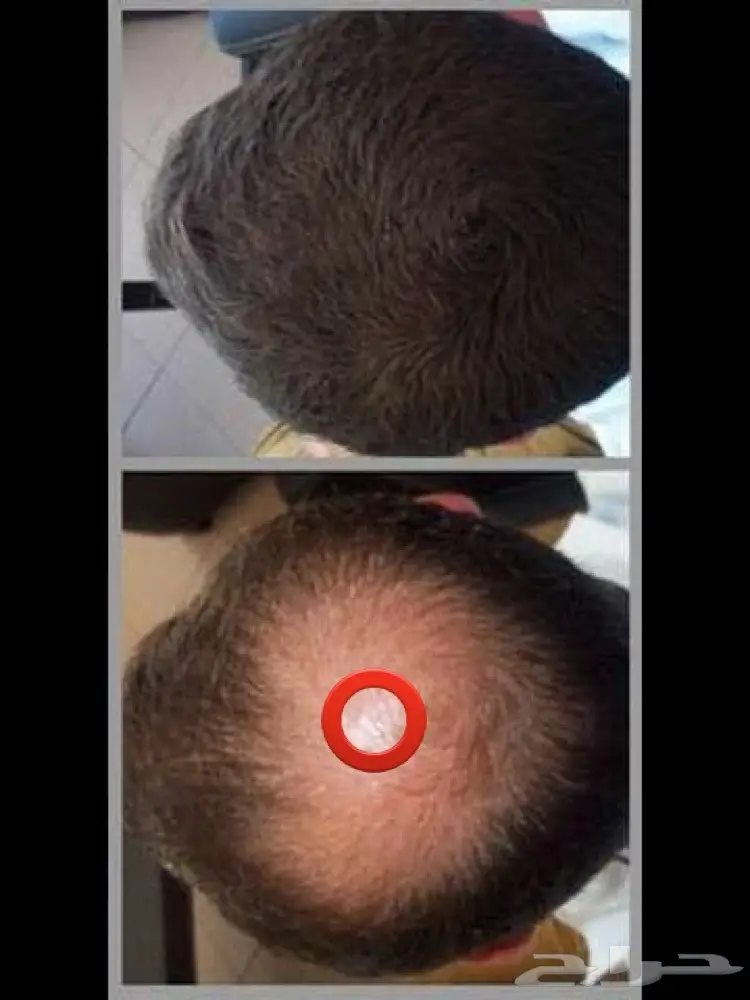 ألياف للصلع(تصفية أشتري 2 والثالث مجانا)  (image 2)