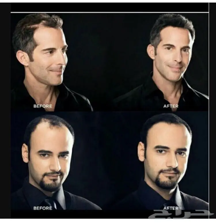 ألياف للصلع(تصفية أشتري 2 والثالث مجانا)  (image 3)