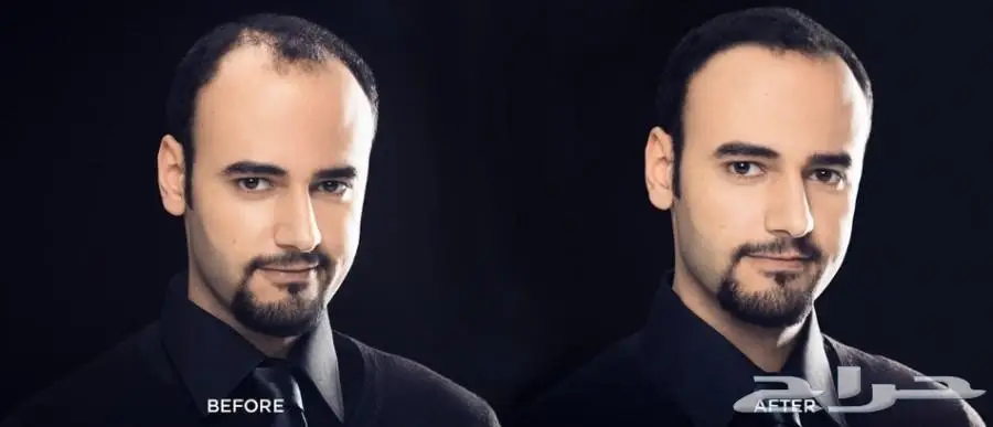 ألياف للصلع(تصفية أشتري 2 والثالث مجانا)  (image 15)