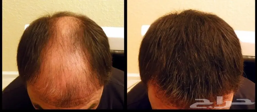 ألياف للصلع(تصفية أشتري 2 والثالث مجانا) 