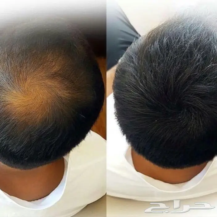 حلول مبتكرة لعلاج تساقط الشعر - الآن بخصم 100! (image 4)