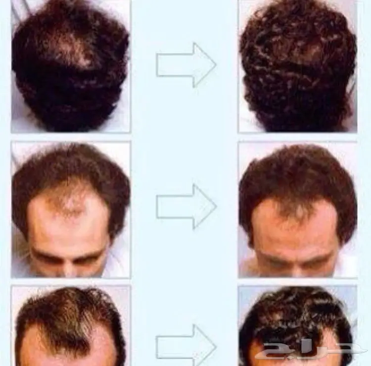 افضل منتج لتطويل وتكثيف الشعرF -6 (image 1)