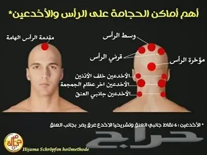 اليوم 19 منافضل اوقات الحجامة (image 2)