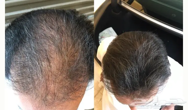 أختراع رهيب يخفي الصلع في ثواني (image 11)