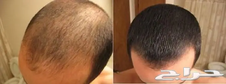 أختراع رهيب يخفي الصلع في ثواني (image 14)