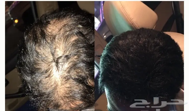 أخفي الصلع في ثواني (image 5)