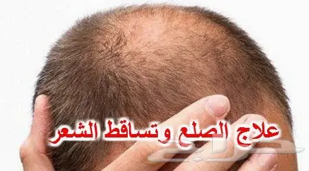 .. V لدينا الحل لإنبات الشعر وتطويله وتكثيفه (image 29)