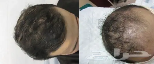 زيت شعر مستورد من أمريكا سد فراغات الشعر  (image 4)