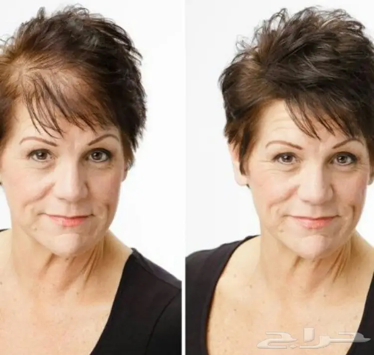 أخفي الصلع فثواتي(لايفوتك العرض) (image 5)