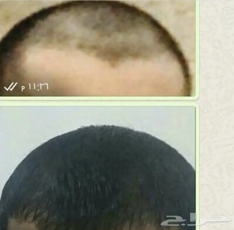 .. V لدينا الحل لإنبات الشعر وتطويله وتكثيفه (image 103)