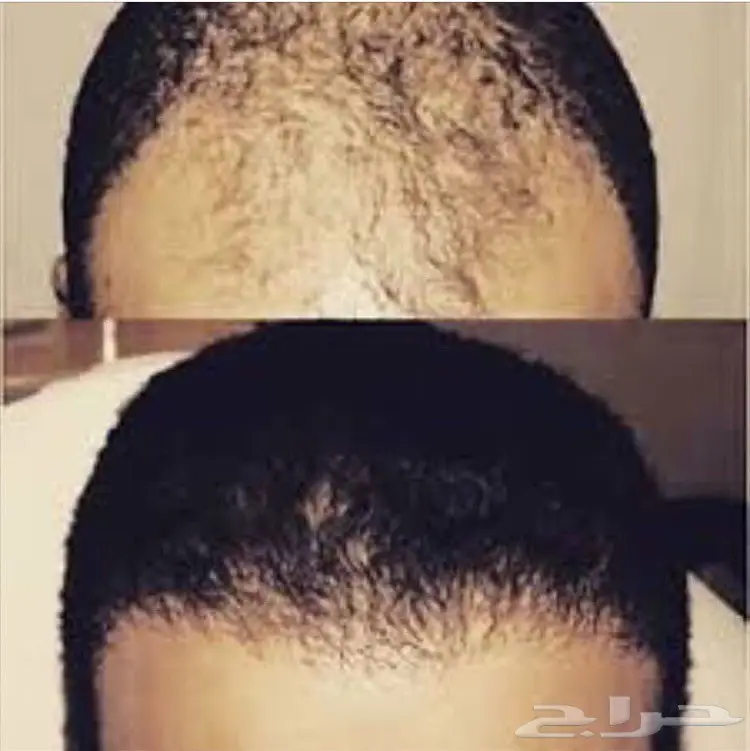 .. V لدينا الحل لإنبات الشعر وتطويله وتكثيفه (image 25)