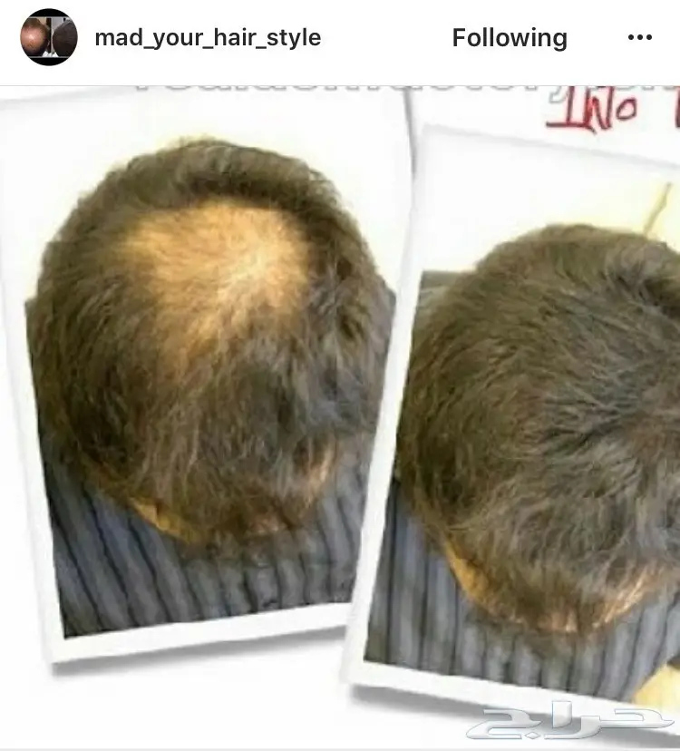 اخفي الصلع في ثواني(لاتفوتك عروضنا) (image 9)