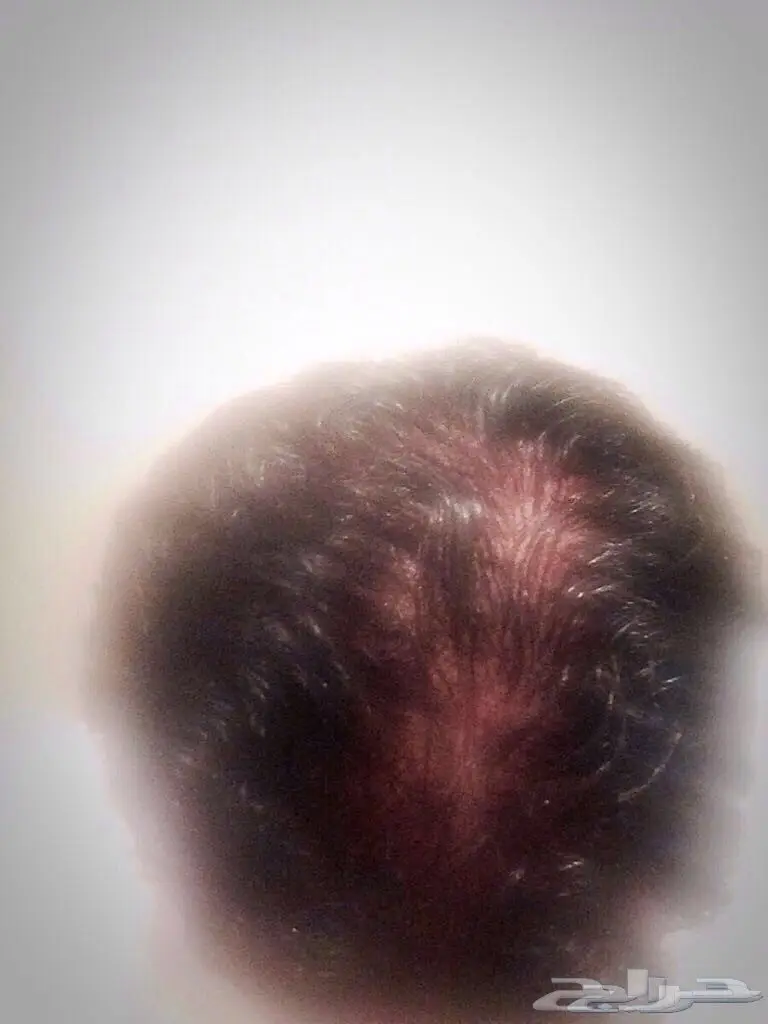  طريقة ممتازة ومجربة لتكثيف الشعر (image 2)