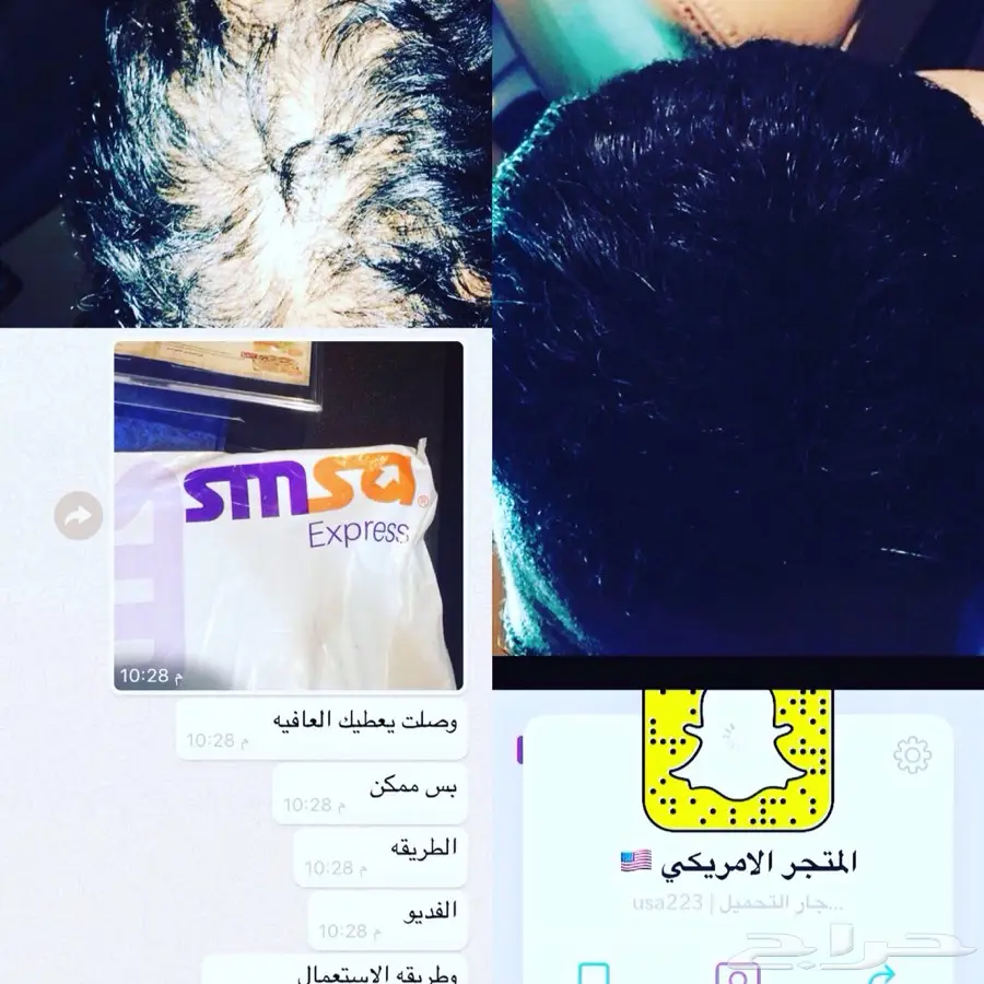 منبت الشعر والصلع الوراثي والفرغات (image 19)