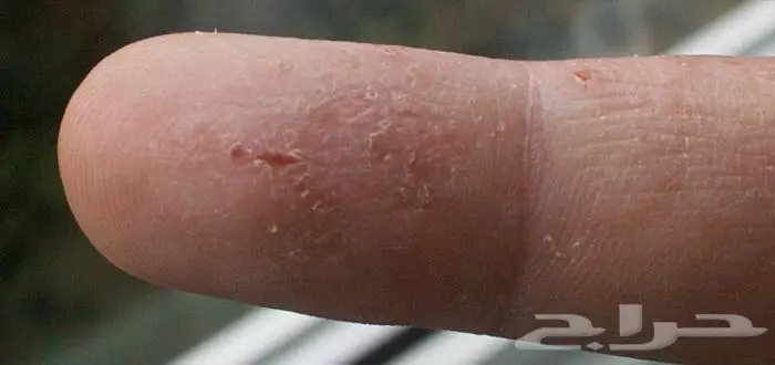 صدفيه  أكزيما فطريات حساسيه (image 4)