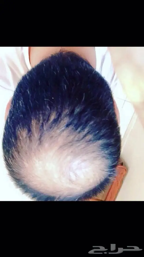 منبت الصلع والفرغات والتساقط مضمون وامن (image 31)