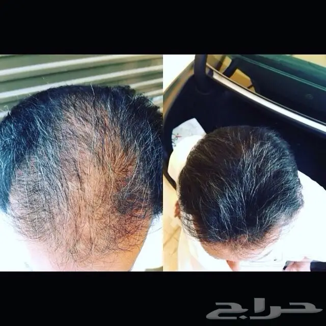 منبت الصلع والفرغات والتساقط مضمون وامن