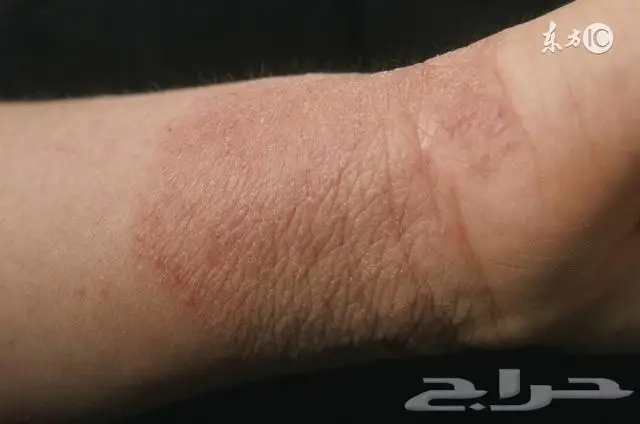 أكزيما صدفيه حساسيه (image 1)