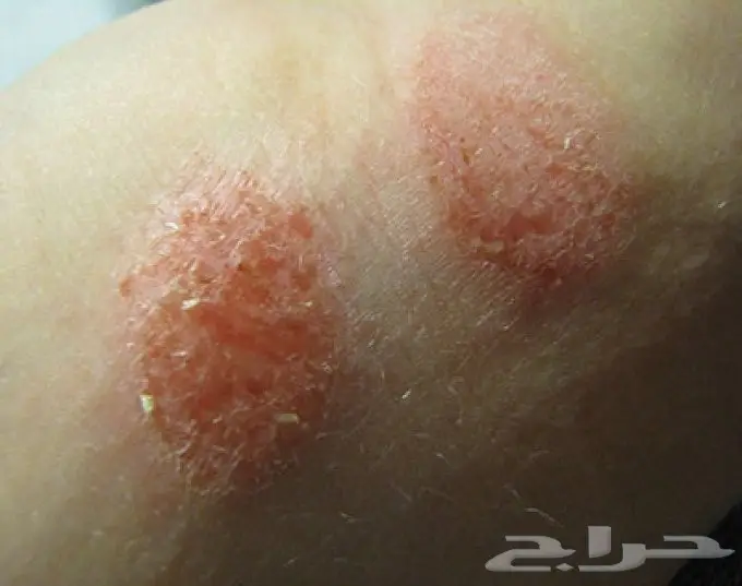 أكزيما صدفيه حساسيه (image 2)
