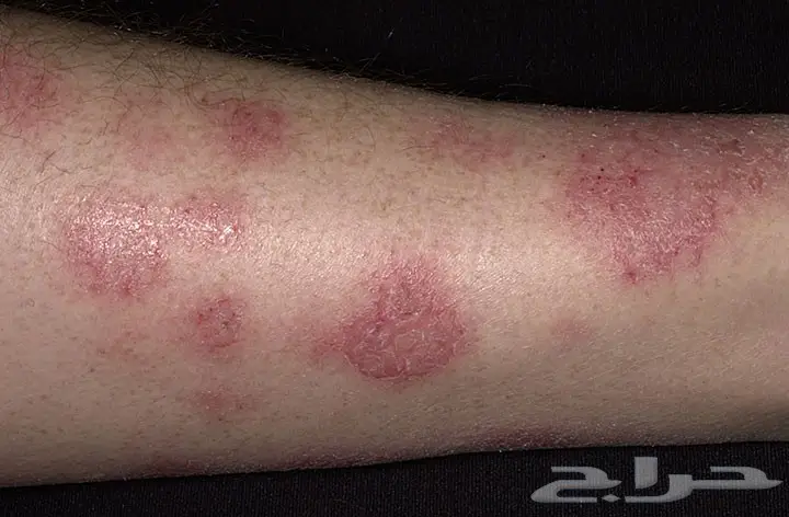 أكزيما صدفيه حساسيه (image 3)