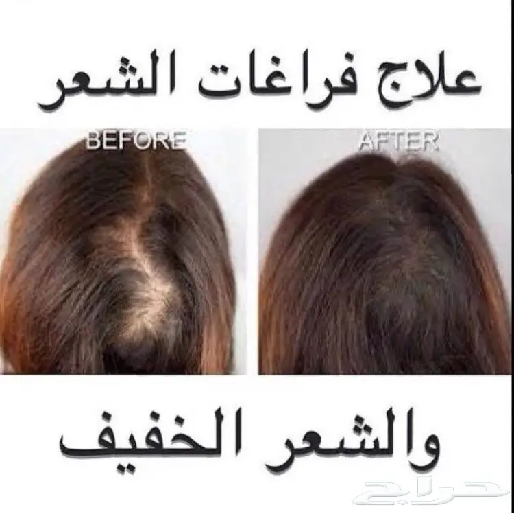 - الحل الامثل لفراغات الشعر والذقن - .. (image 65)