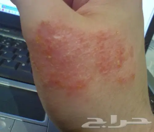 أكزيما صدفيه حساسيه (image 3)