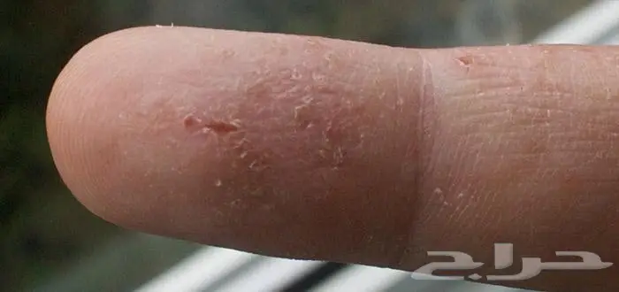 أكزيما صدفيه حساسيه (image 5)