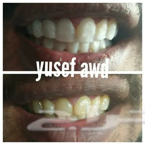 ابتسامة فينير متحرك (image 1)