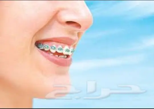 تقويم اسنان بأقل الأسعار 99 فقط (image 2)