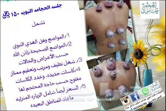 الحجامة المنزلية في جدة: خبرة علمية وعملية (image 3)