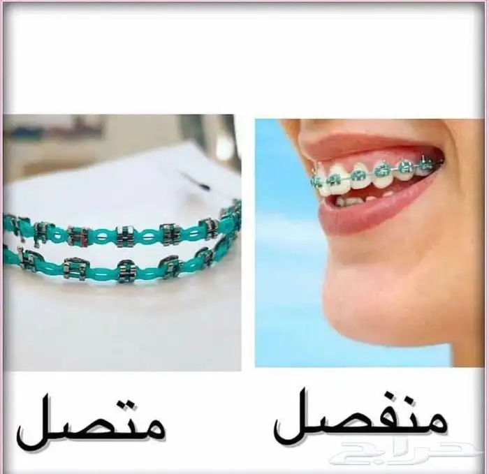 تقويم أسنان زينة 8