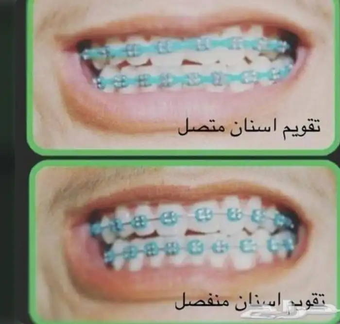 تقويم أسنان زينة 8