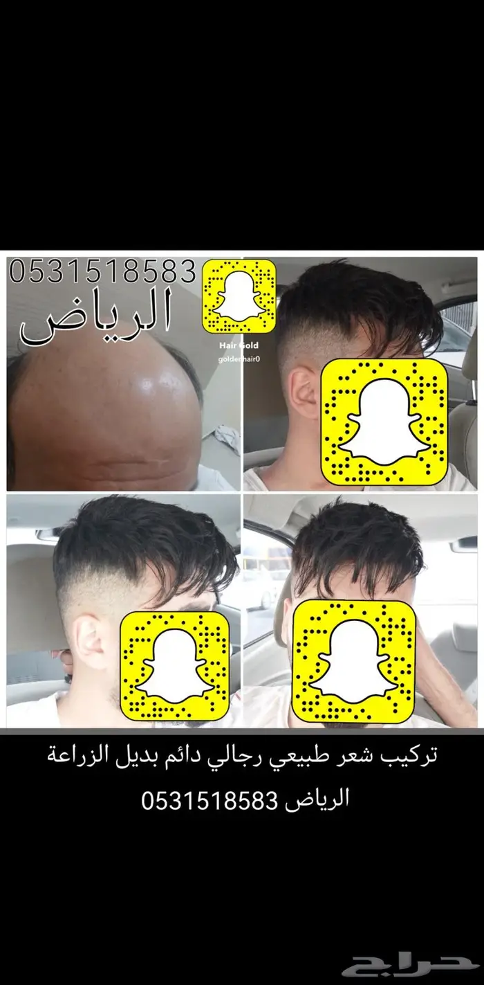 بوستيجه للصلع بديل للزراعة 7