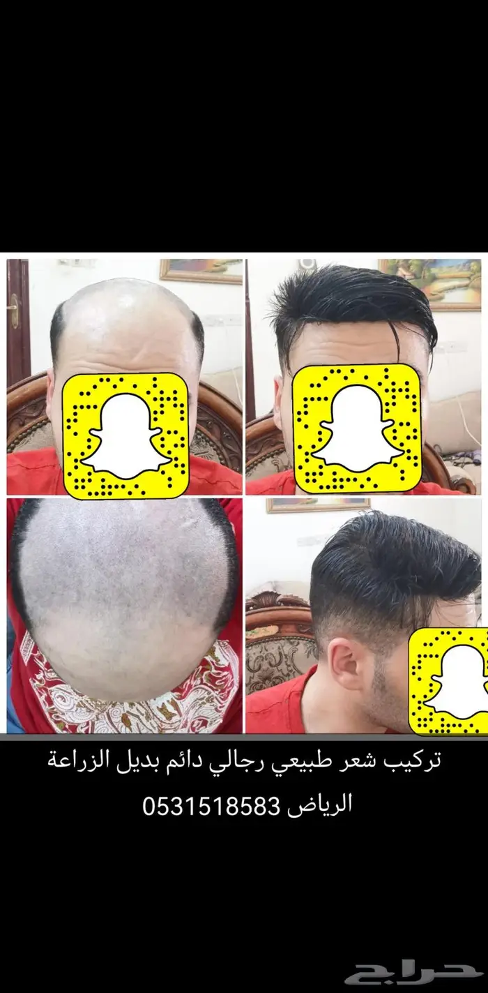 بوستيجه للصلع بديل للزراعة 16