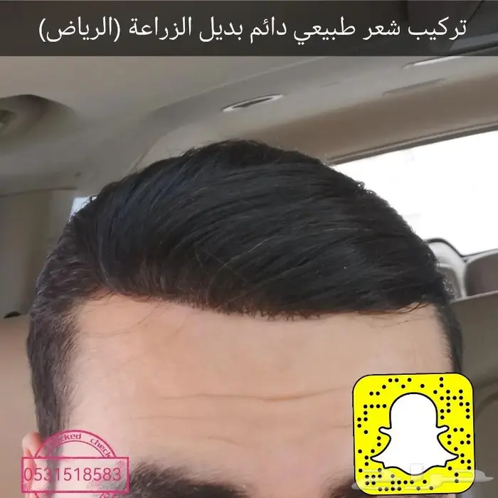 بوستيجه للصلع بديل للزراعة 5
