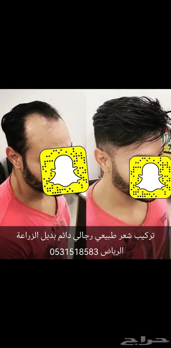 تركيب شعر بشري دائم طبيعي بوستيجه 7
