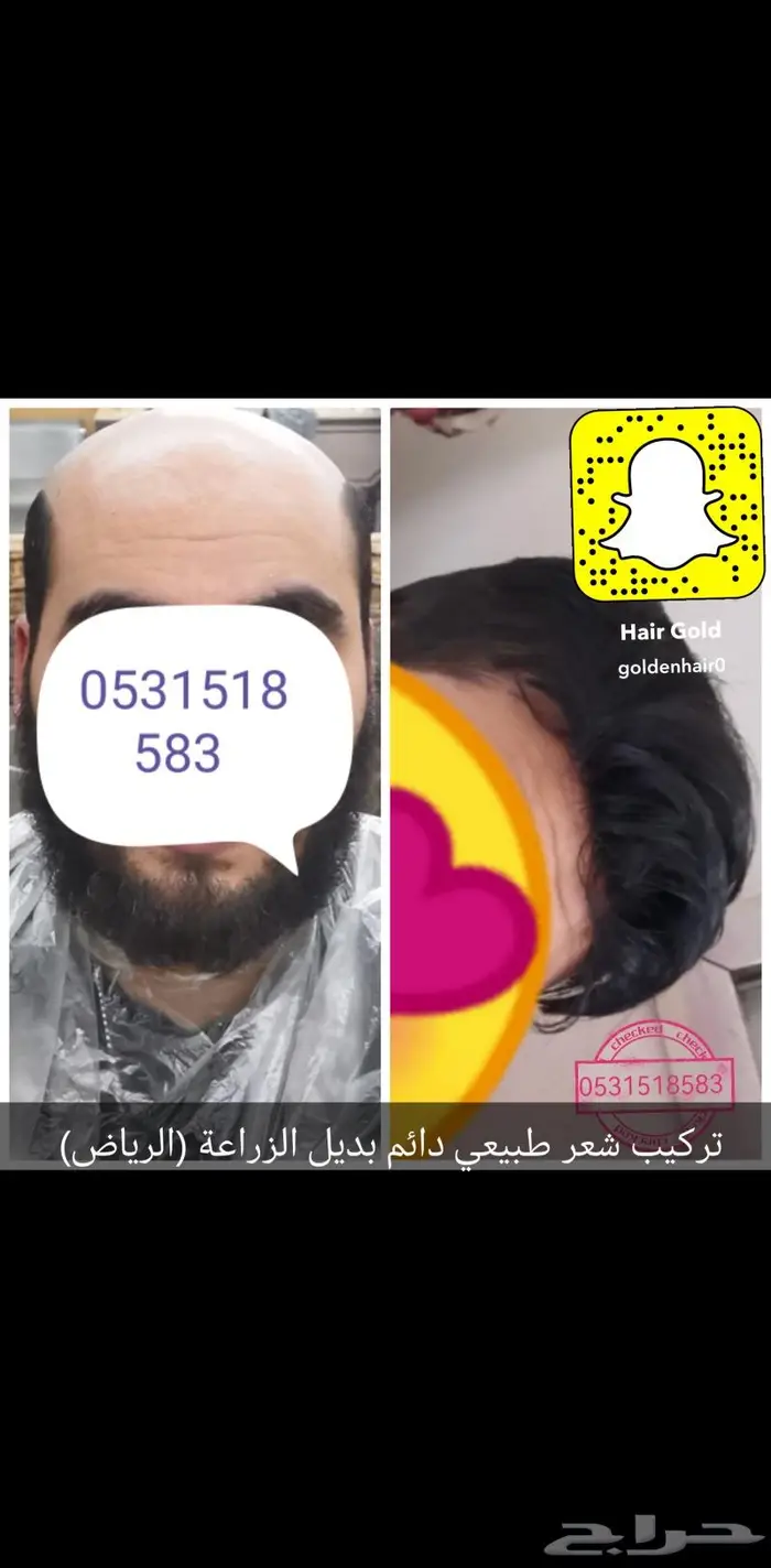 تركيب شعر بشري دائم طبيعي بوستيجه 15
