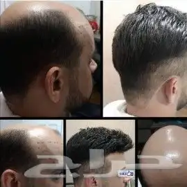 باروكه للرجال تركيب شعر 6