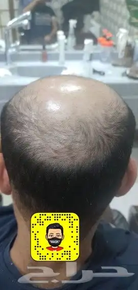 باروكه للرجال تركيب شعر 2